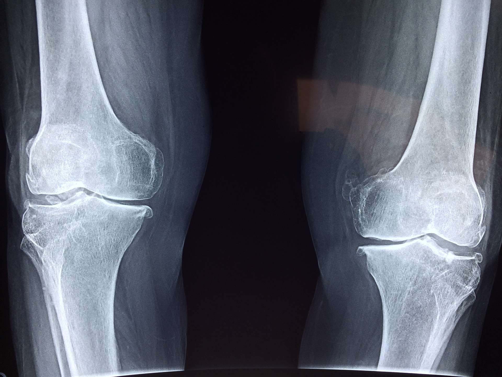knee 2253047 1920